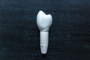 Image of a ceramic dental implant at Oakley Oral Surgery.